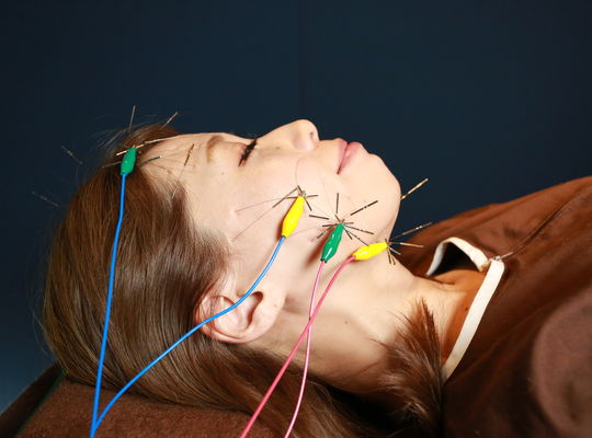 アンチエイジング美容鍼